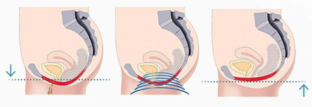 EmSella Before After Dr Julia Ward